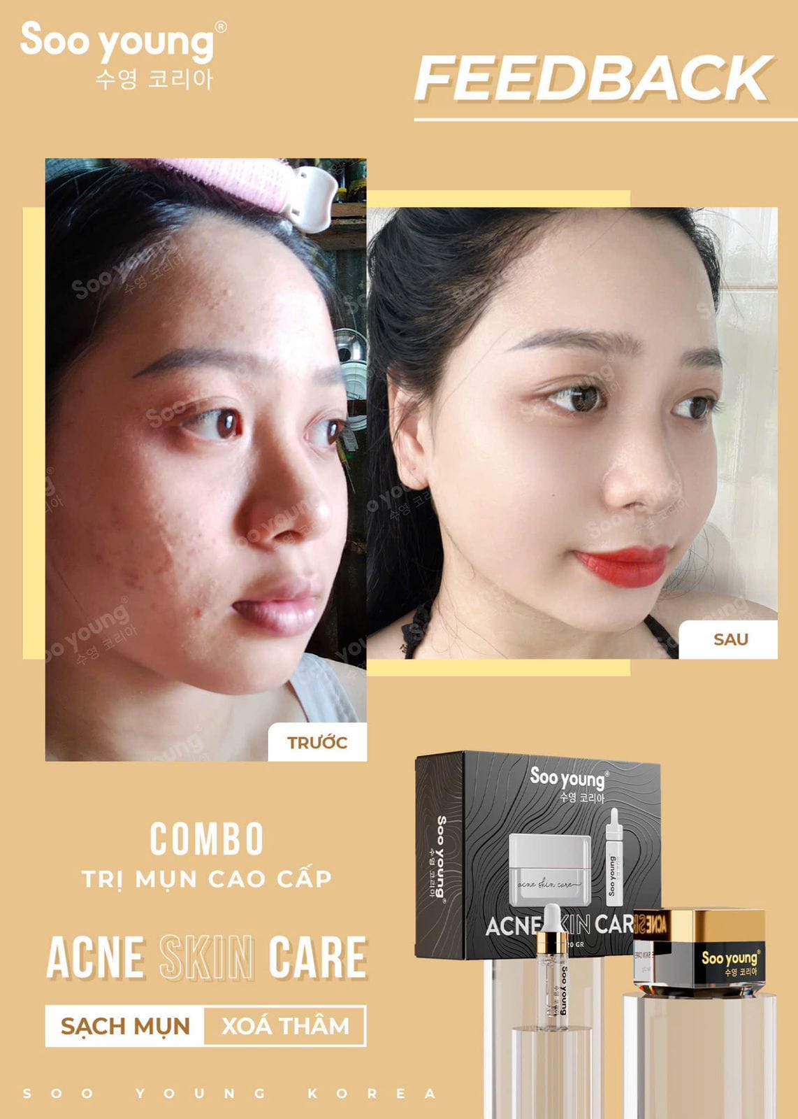 Acne Skin Care Soo Young Anti-Acne Combo Set 4